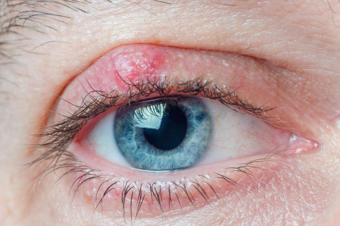 Blepharitis Management Can Extensions Still Be Applied