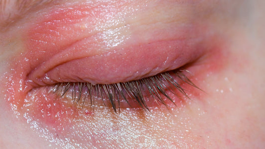 Blepharitis from Eyelash Extensions: What Every Lash Artist Should Know
